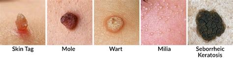 skin tags causes prevention removal