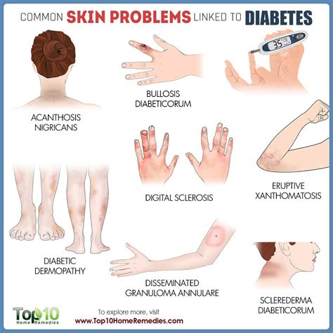 common skin problems linked  diabetes top  home remedies