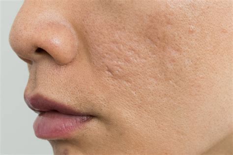 Your Quick Guide To The Best Acne Scar Treatment Elite