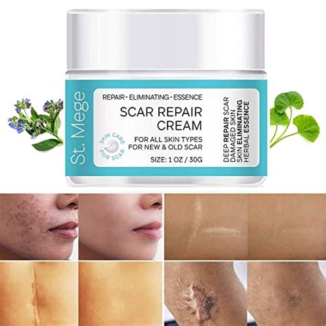 scar removal cream  thailand review  buying guide