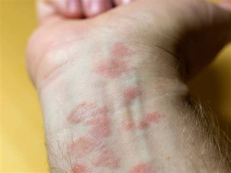 tiny red spots  skin bumps itchy  itchy   rid treatment nubo beauty