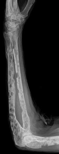 multiplemyelomalyticbonelesions multiple myeloma myeloma