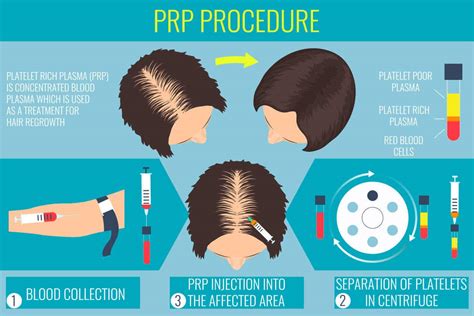 Platelet Rich Plasma Hair Therapy Prp Injections Are A