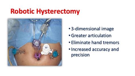 hysterectomy