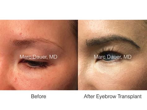 eyebrow restoration los angeles eyebrow transplant procedure