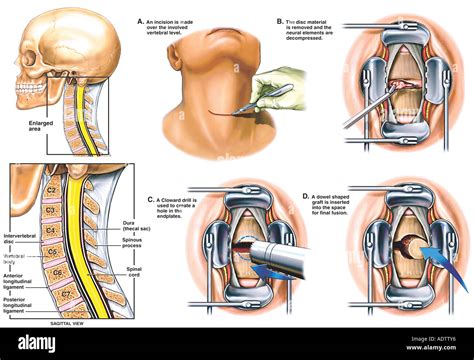 Cloward Anterior Cervical Discectomy And Fusion Stock