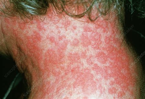 skin rash caused  allergy  drug bactrim stock image