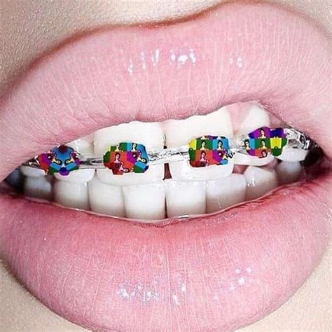 pin by trinh nguyen on its cool to have braces dental braces lip art