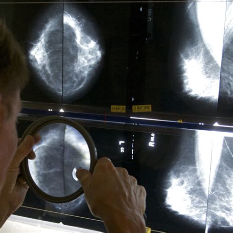 u s requires new info on breast density with all mammograms