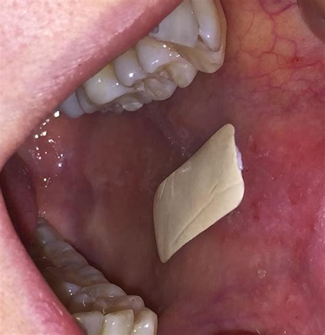 plaster which sticks inside the mouth could improve treatment of oral