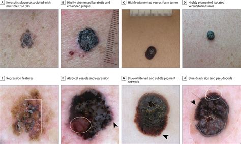 dermoscopic clues  diagnosing melanomas  resemble seborrheic
