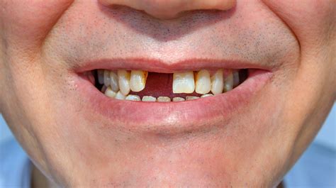 missing teeth adelaide dental