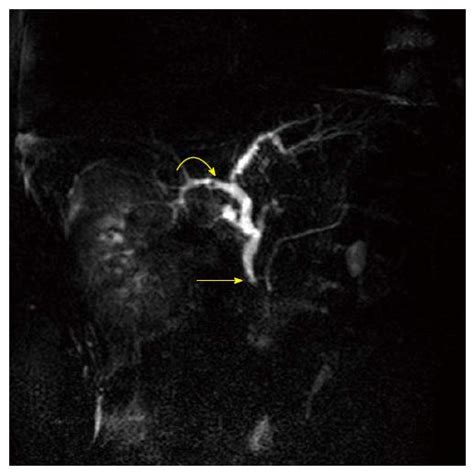 accuracy of magnetic resonance cholangiography compared to operative endoscopy in detecting