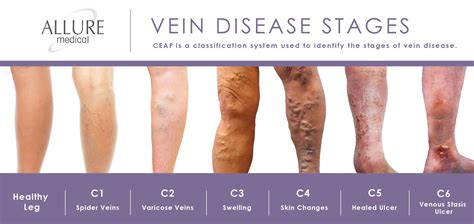 classification  venous disease