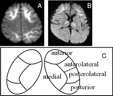 Thalamic Lesions In Acute Encephalopathy With Biphasic Seizures And