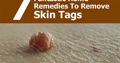 7 fantastic home remedies to remove skin tags diy craft projects