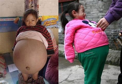 Photos 4 Year Old Girl 9 Months Pregnant With Brother’s Twins