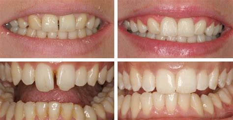 gaps and missing teeth dental implants dentist evesham