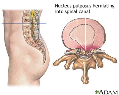 herniated nucleus pulposus medlineplus medical encyclopedia image