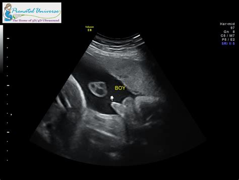 4d Hd Ultrasound Image Gallery Prenatal Universe Ultrasound
