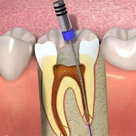 endodontia canal odontocompany
