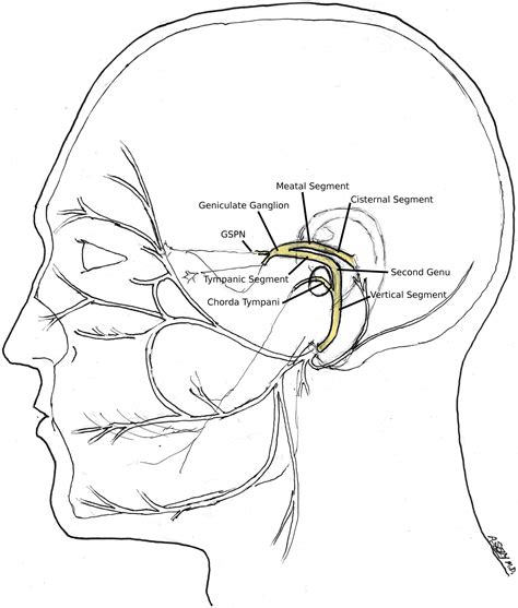 temporal bone fracture requiring facial nerve