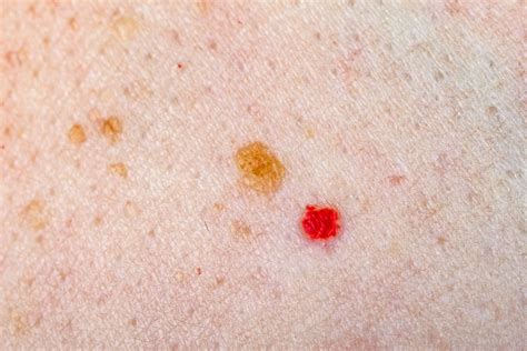 small red spots  skin cheap price save  jlcatjgobmx