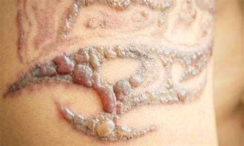 update   tattoo laser treatment  indaotaonec