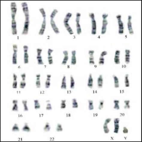 Karyotype Of A Syndrome Klinefelter 47 Xxy Open I