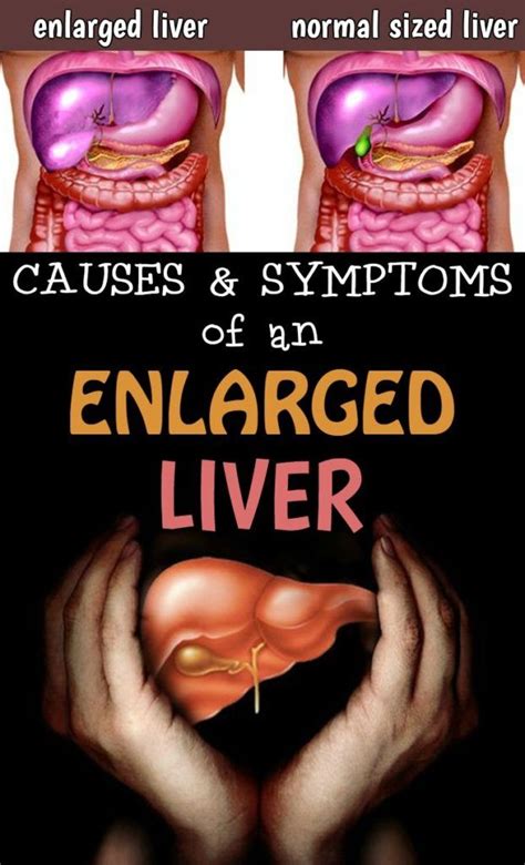 causes and symptoms of an enlarged liver