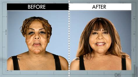 Concrete In Her Face From Botched Patients Before And After—shocking
