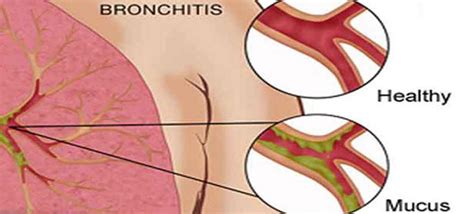 indications of bronchitis is bronchitis contagious