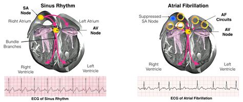 atrial fibrillation ablation melbourne heart rhythm