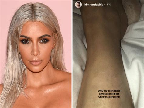 Here S Everything You Need To Know About Psoriasis Kim
