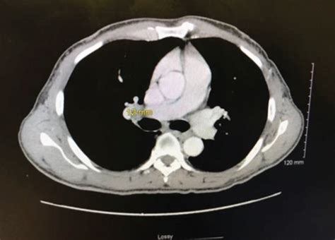 Ct Chest With Contrast Imaging Of Right Hilar Mass Download