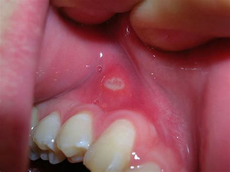 White Patches In Mouth Causes And Treatments New Health