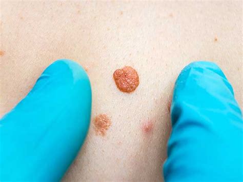 six simple hacks to get rid of skin tags at home