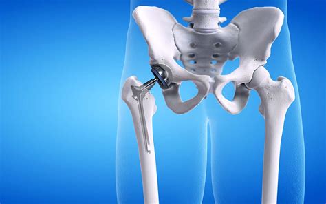 pros and cons of hip replacement surgery ibji