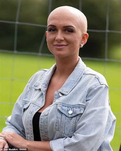 alopecia sufferer 27 sick of struggling to cover up her bald patches