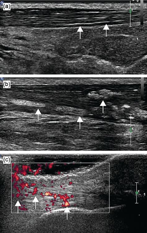 Ultrasound Characteristics Of The Achilles Tendon In