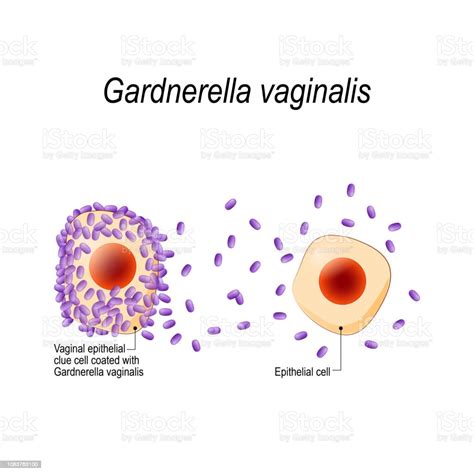 Vaginal Epithelial Clue Cell Coated With Gardnerella Vaginalis Stock