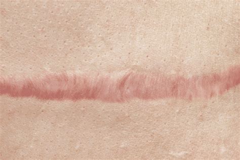 scar  thicker scarfade scar treatment gel