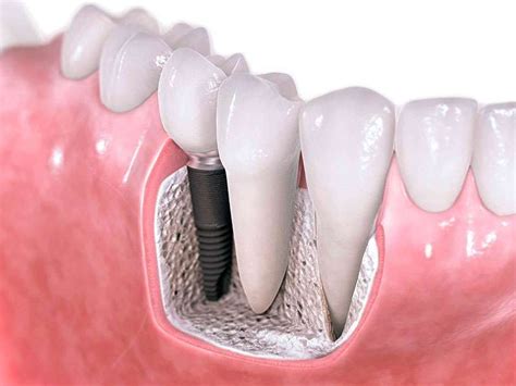 quanto custa um implante dentário completo consulta ideal