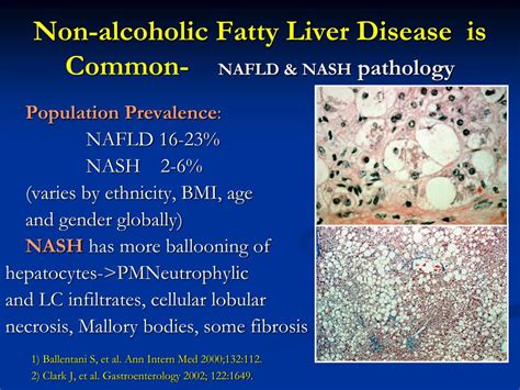 Ppt Non Alcoholic Fatty Liver Disease In Pcos Powerpoint