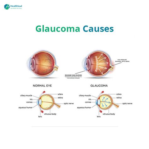 Glaucoma Symptoms Diagnosis And Treatment – Healthsoul