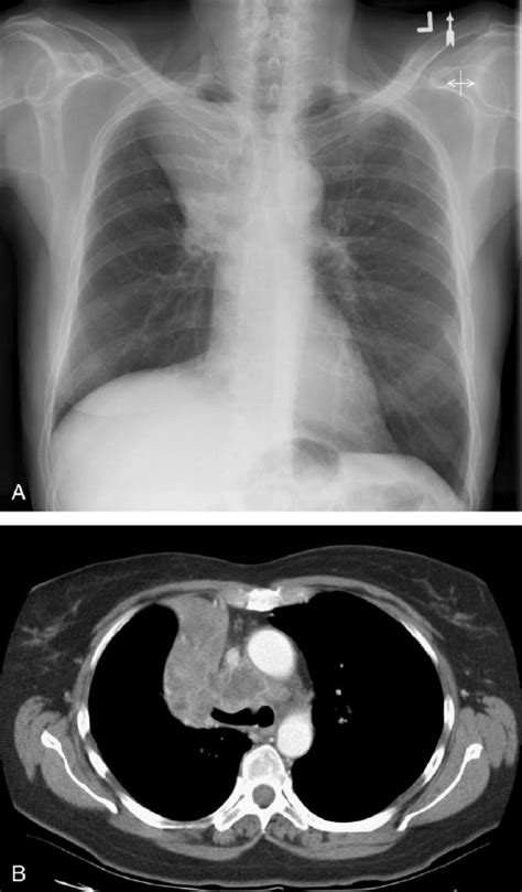 Golden S Sign Patient With Right Upper Lobe Collapse Frontal Chest