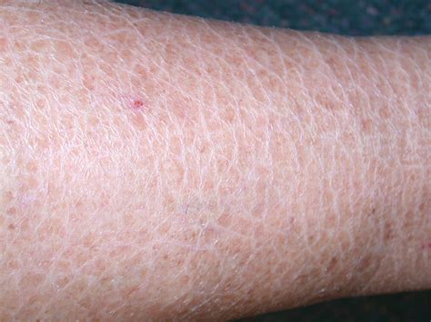 dry scaly patches  skin pictures