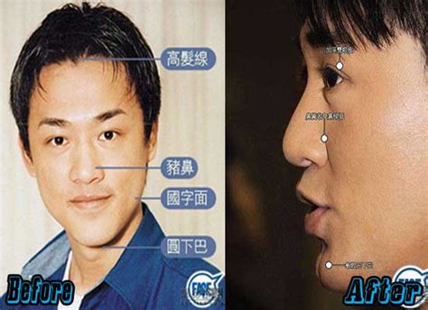 Zhang Yu Xi Plastic Surgery Before And After Celebrity