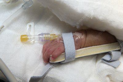 cannula  neonates hand stock image  science photo library