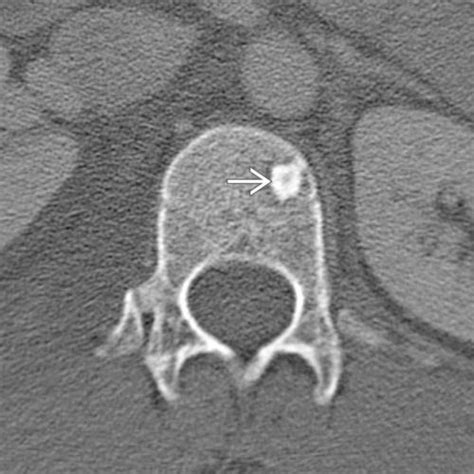 Sclerotic bone lesion of the spine